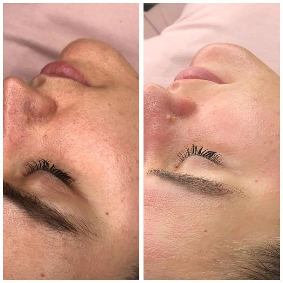 Resultado del tratamiento