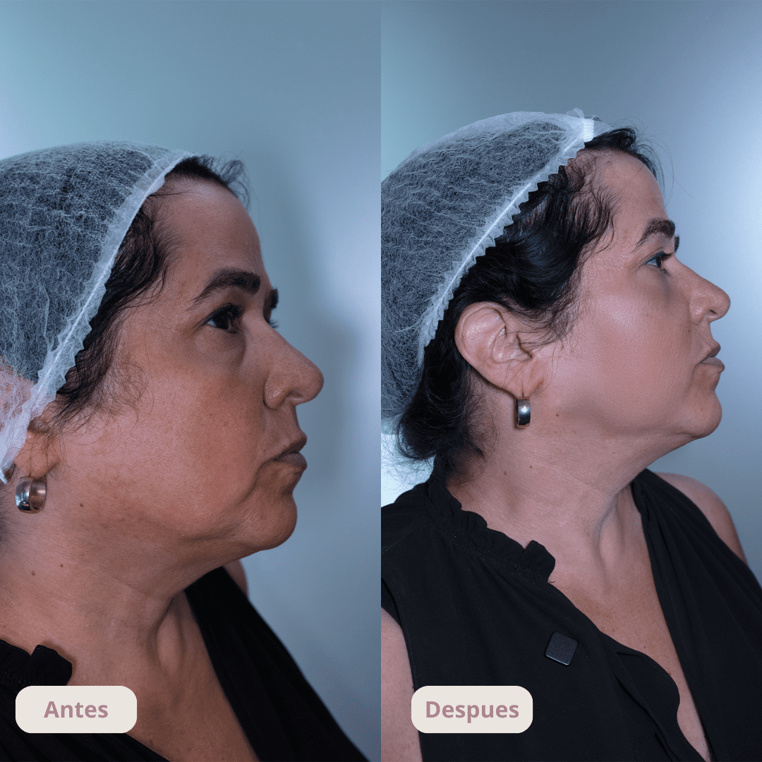 Resultado del tratamiento