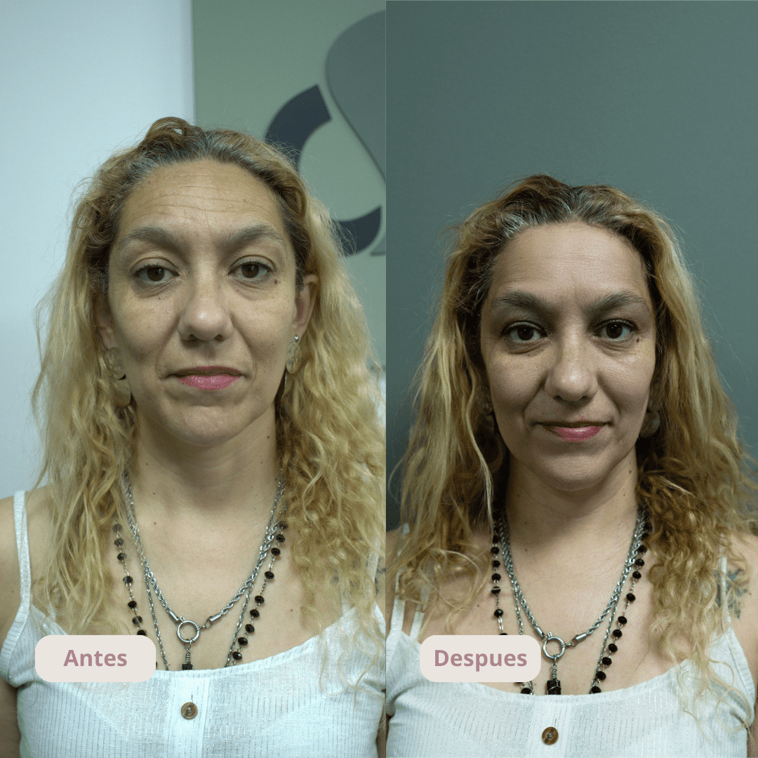 Resultado del tratamiento