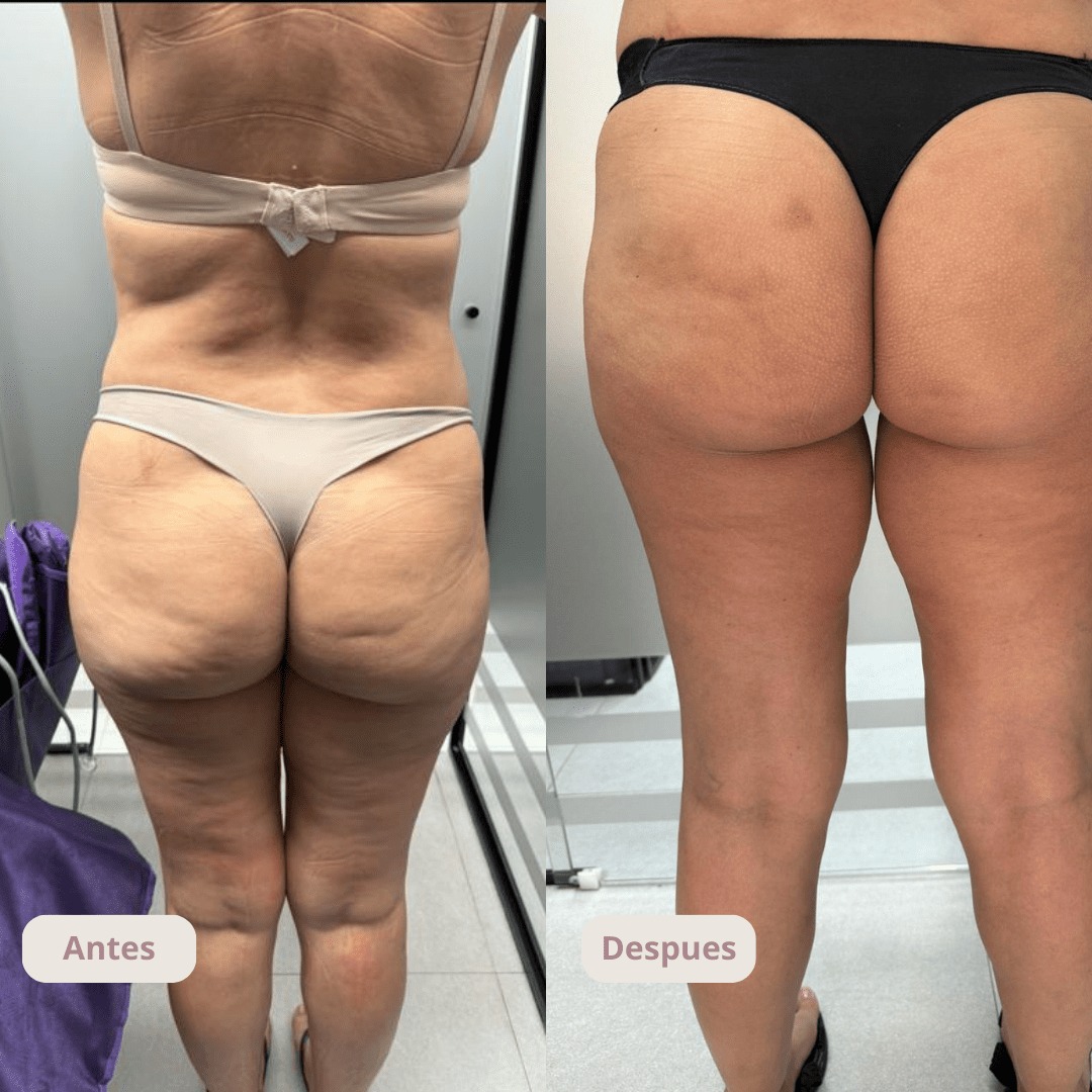 Resultado del tratamiento