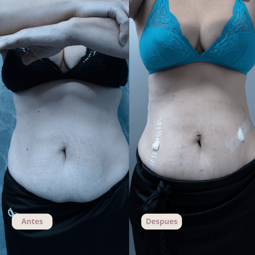 Resultado del tratamiento