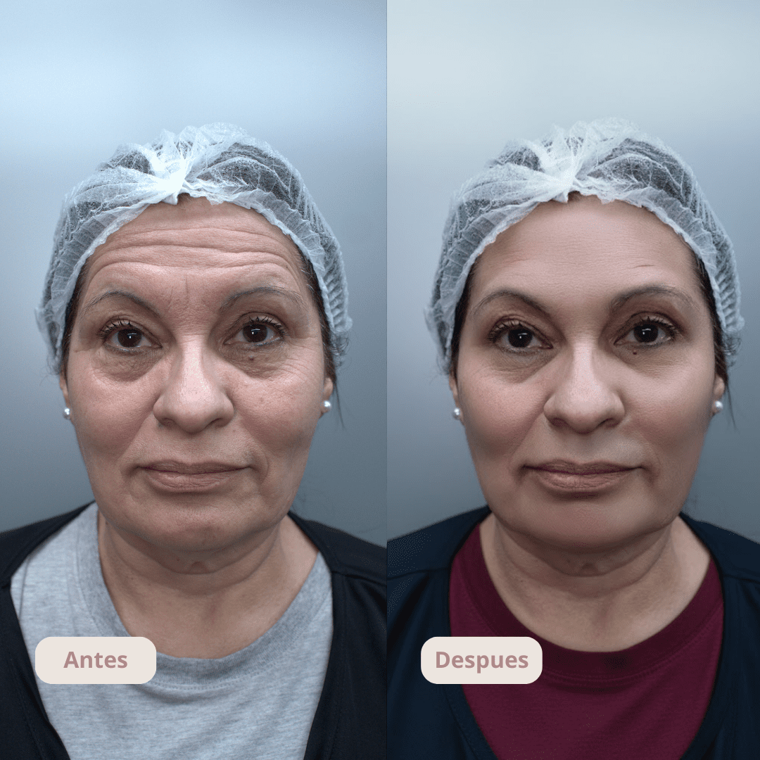 Resultado del tratamiento