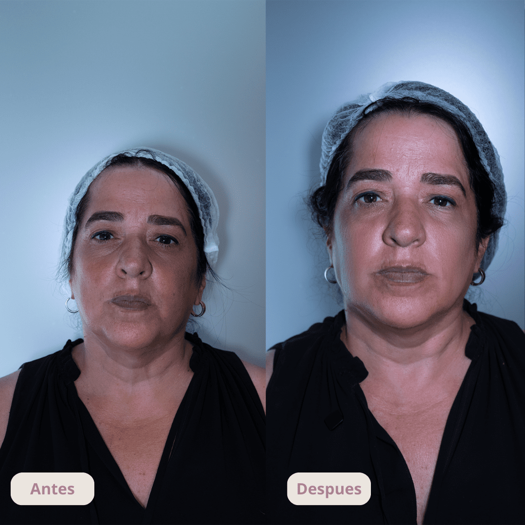 Resultado del tratamiento