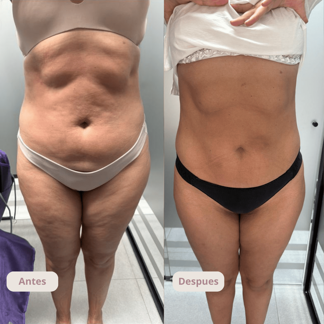 Resultado del tratamiento