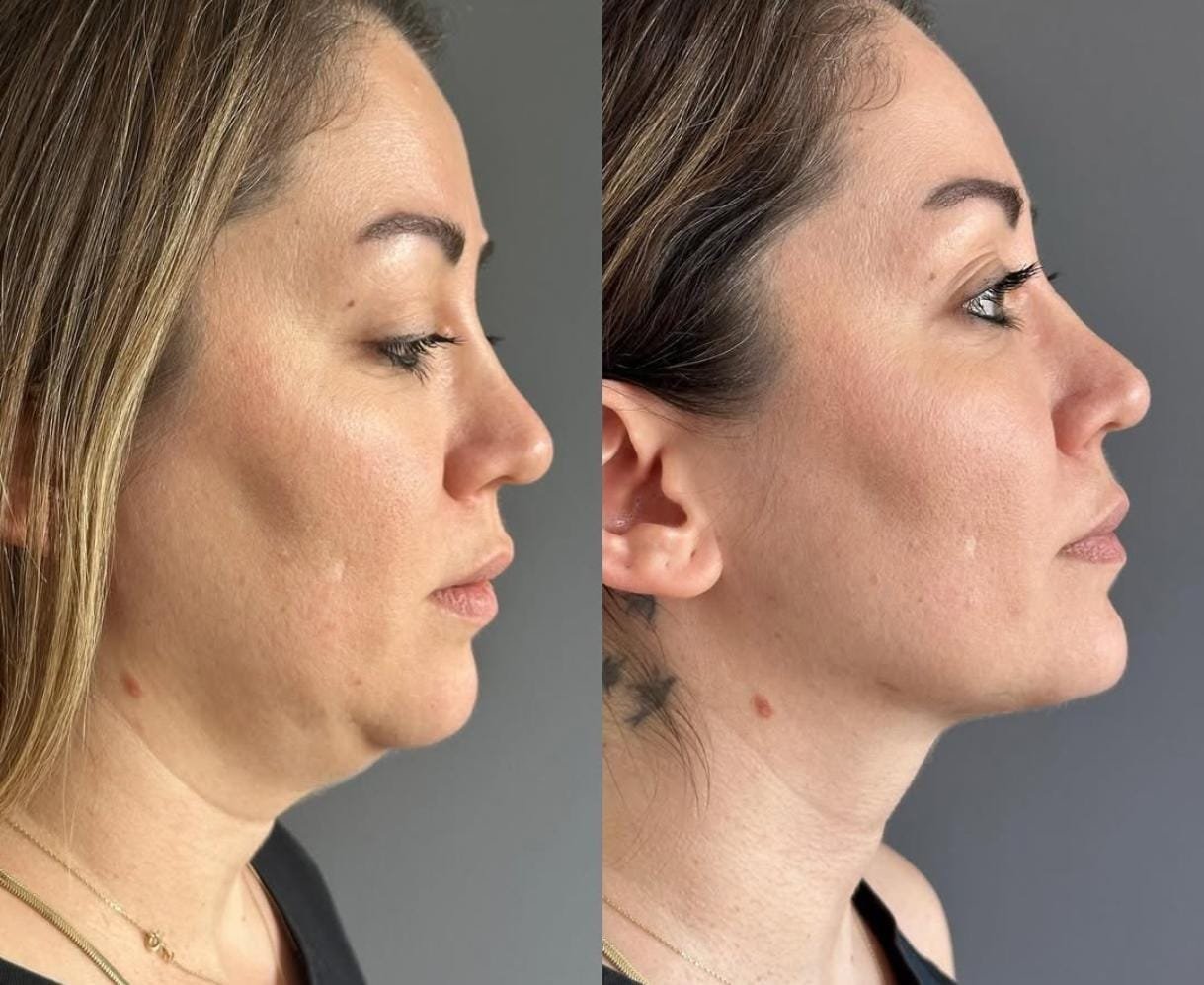 Resultado del tratamiento