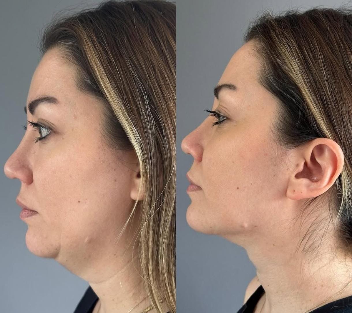 Resultado del tratamiento