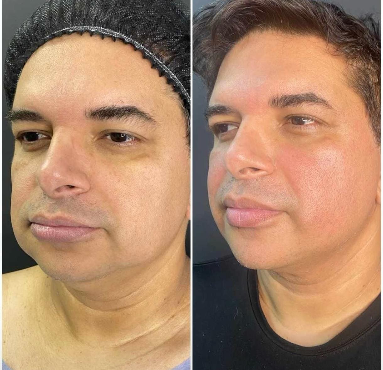 Resultado del tratamiento