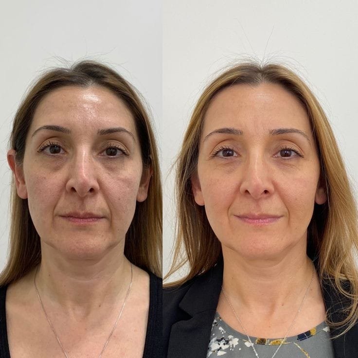 Resultado del tratamiento