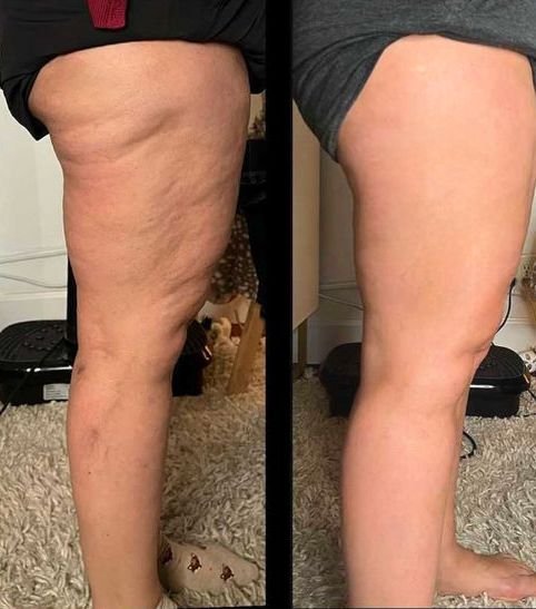 Resultado del tratamiento