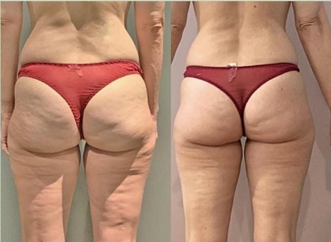 Resultado del tratamiento