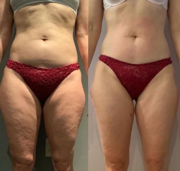 Resultado del tratamiento