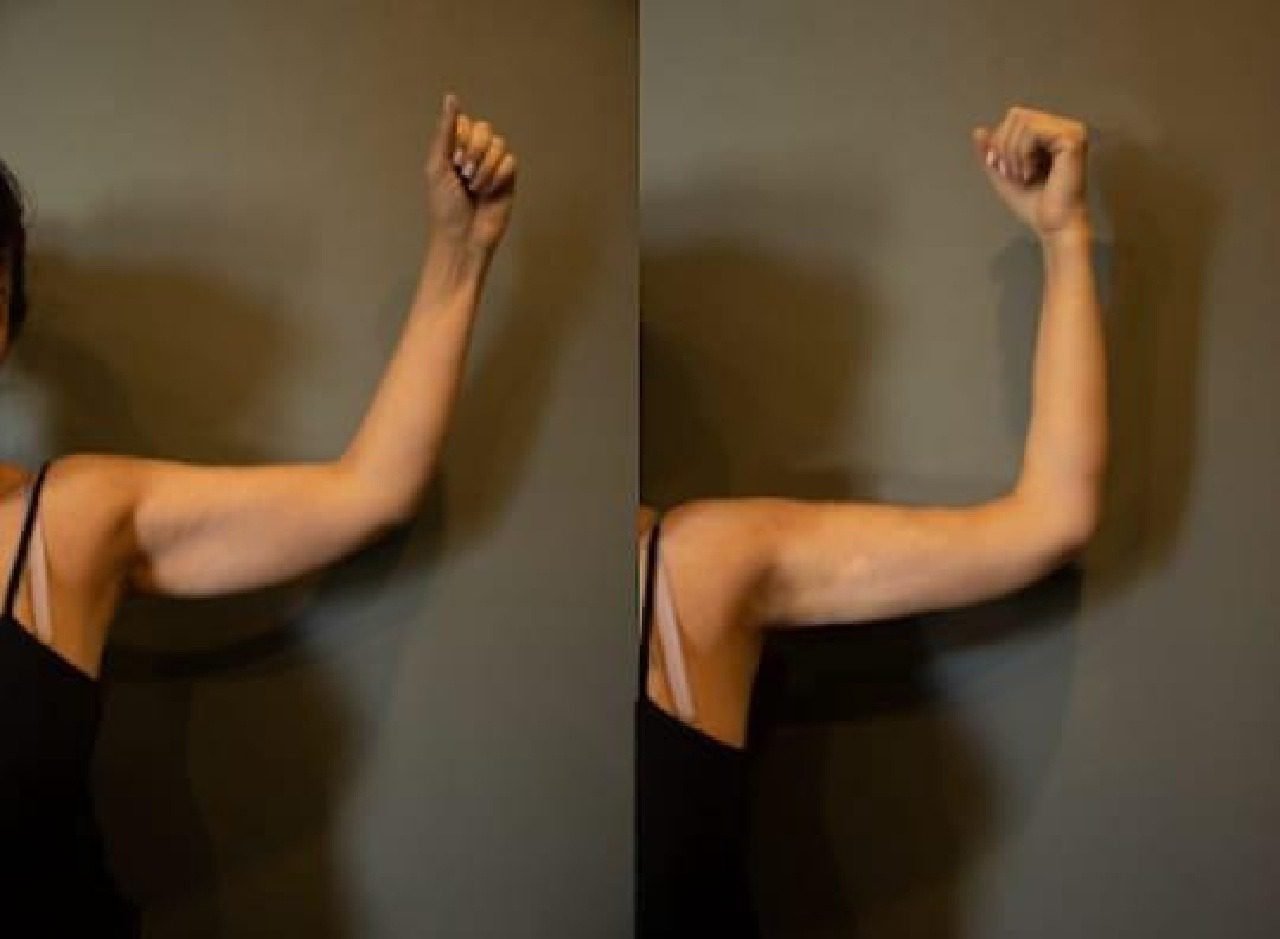 Resultado del tratamiento