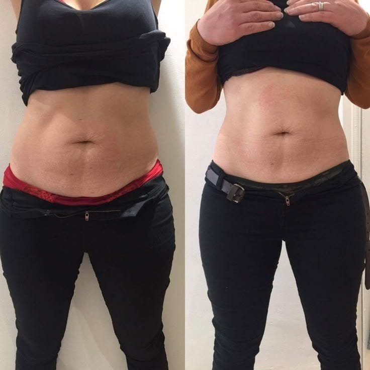 Resultado del tratamiento