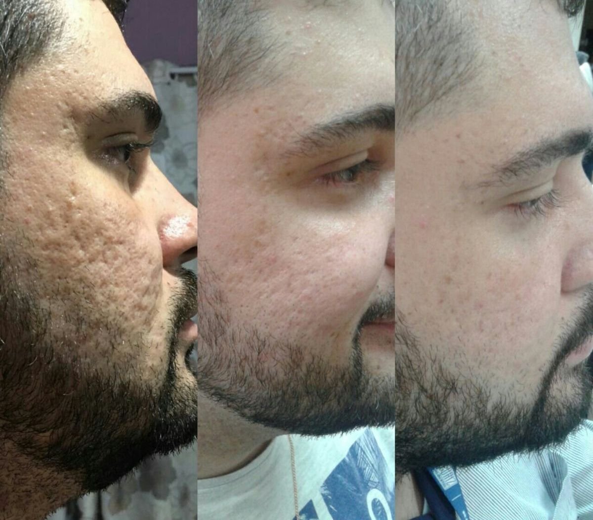 Resultado del tratamiento